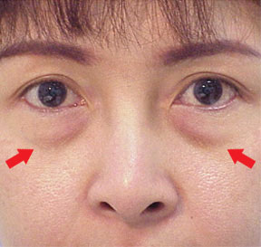 eyelid surgery, blepharoplasty