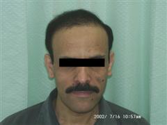 hair restoration bangkok