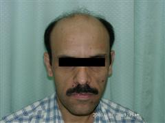 hair restoration thailand