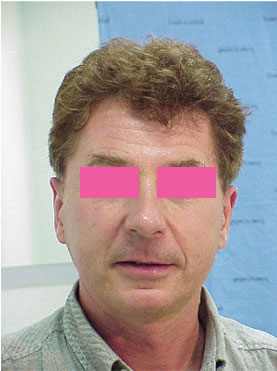 forehead lift