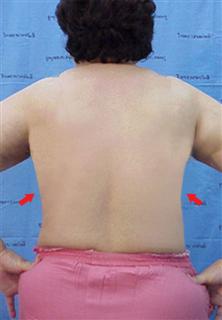 lipoplasty