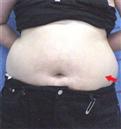 liposculpture