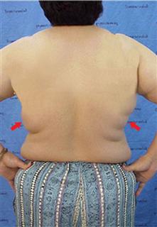 liposuction