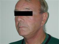 neck lift thailand