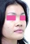 nose implant, nose reshaping