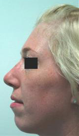 rhinoplasty